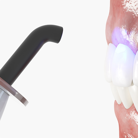 Illustration of an ultraviolet light being applied to a tooth