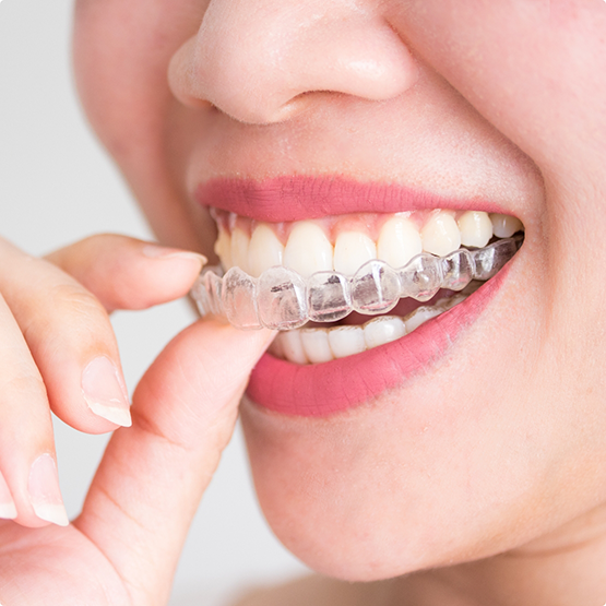 Person placing an Invisalign clear aligner over their teeth