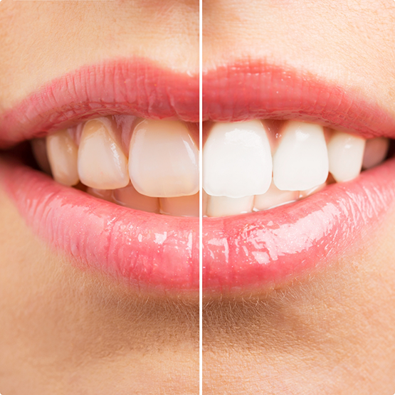 Close up of a smile before and after teeth whitening