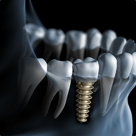 Illustrated x-ray of a mouth with a dental implant
