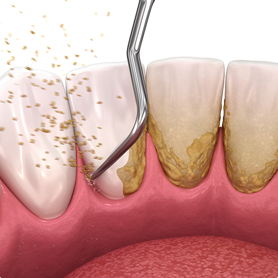 Illustration of a dental instrument clearing tartar and plaque from the teeth and gums