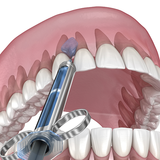 Illustration of antibiotics being applied to the gums