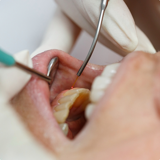 Close up of a patient's gums being treated with a laser
