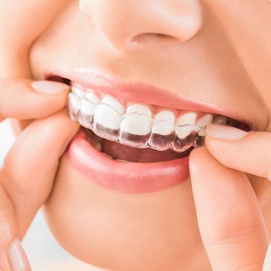 Person placing a clear aligner over their teeth